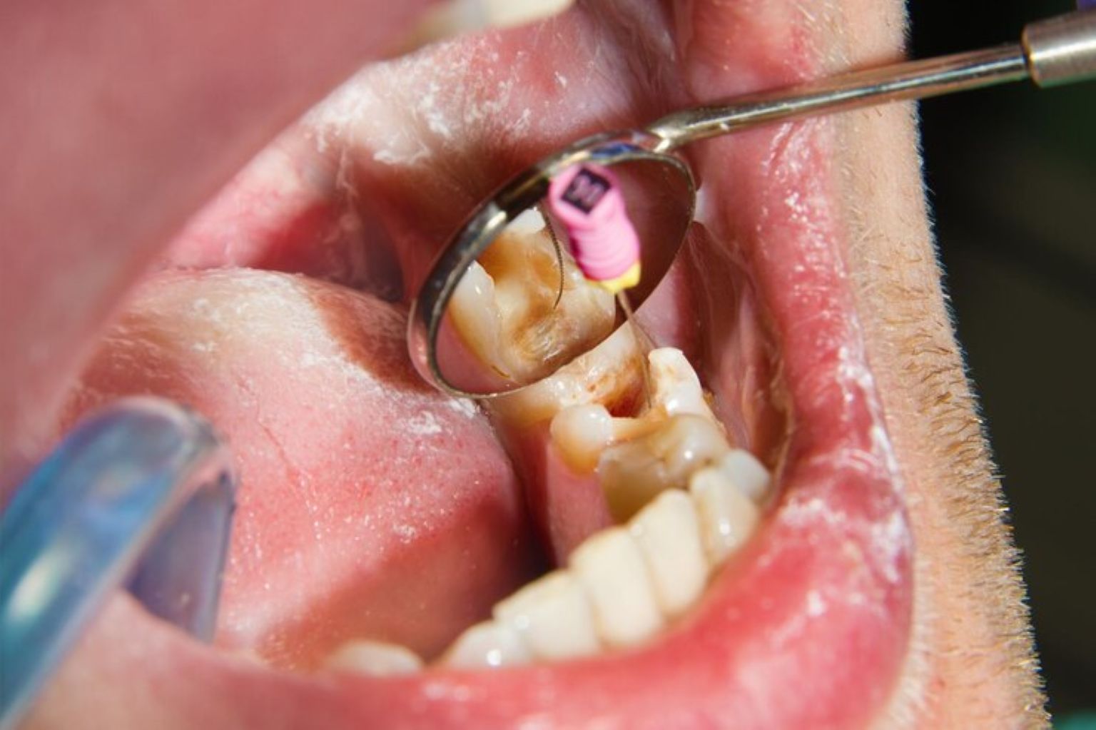 Are Composite Fillings Safe & Mercury-Free? Facts Every Patient Should Know